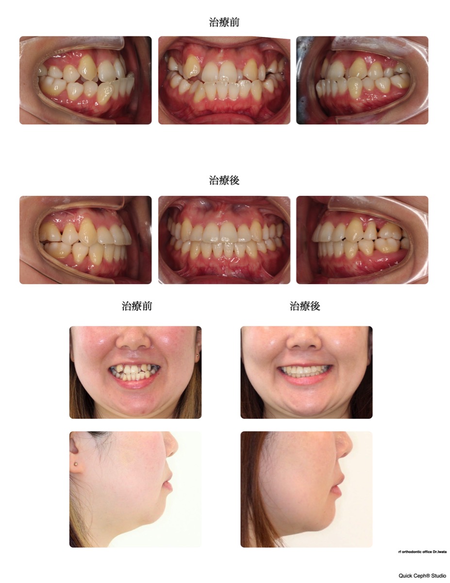 反対咬合症例 　＜重度叢生を伴う反対咬合に対する抜歯矯正治療＞