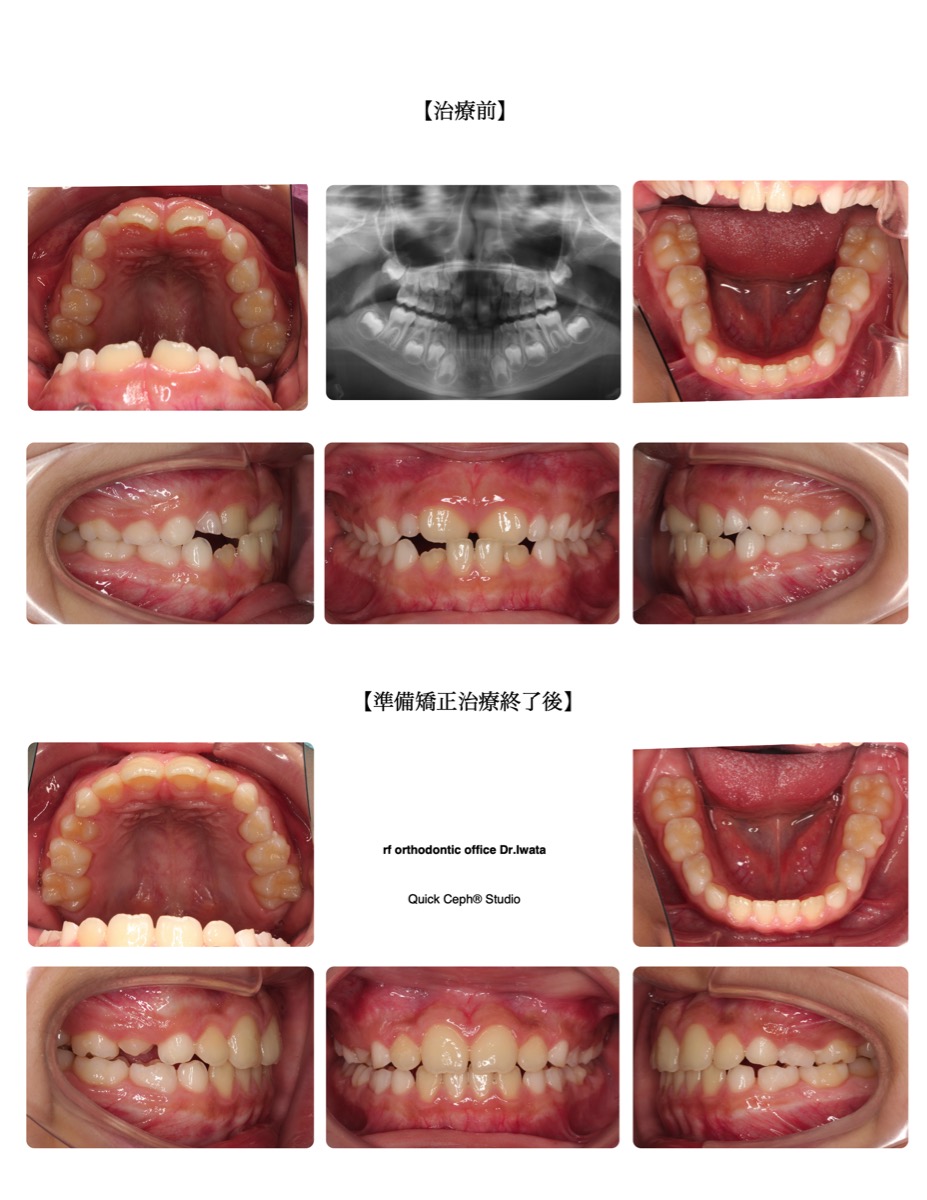 反対咬合症例　＜上顎前歯の翼状捻転を伴う反対咬合に対する準備矯正治療＞