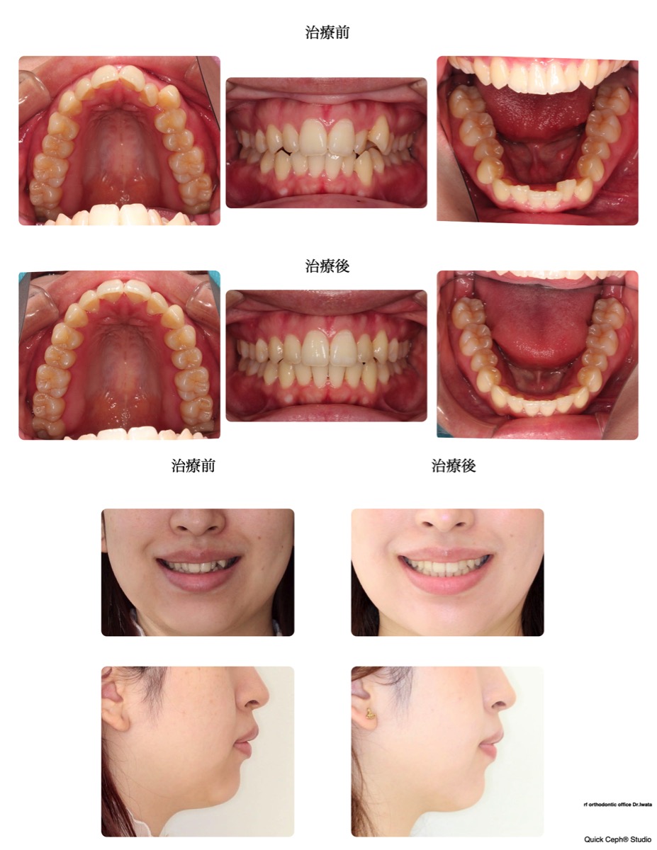 叢生症例　＜歯列狭窄を伴う叢生に対する非抜歯矯正治療＞