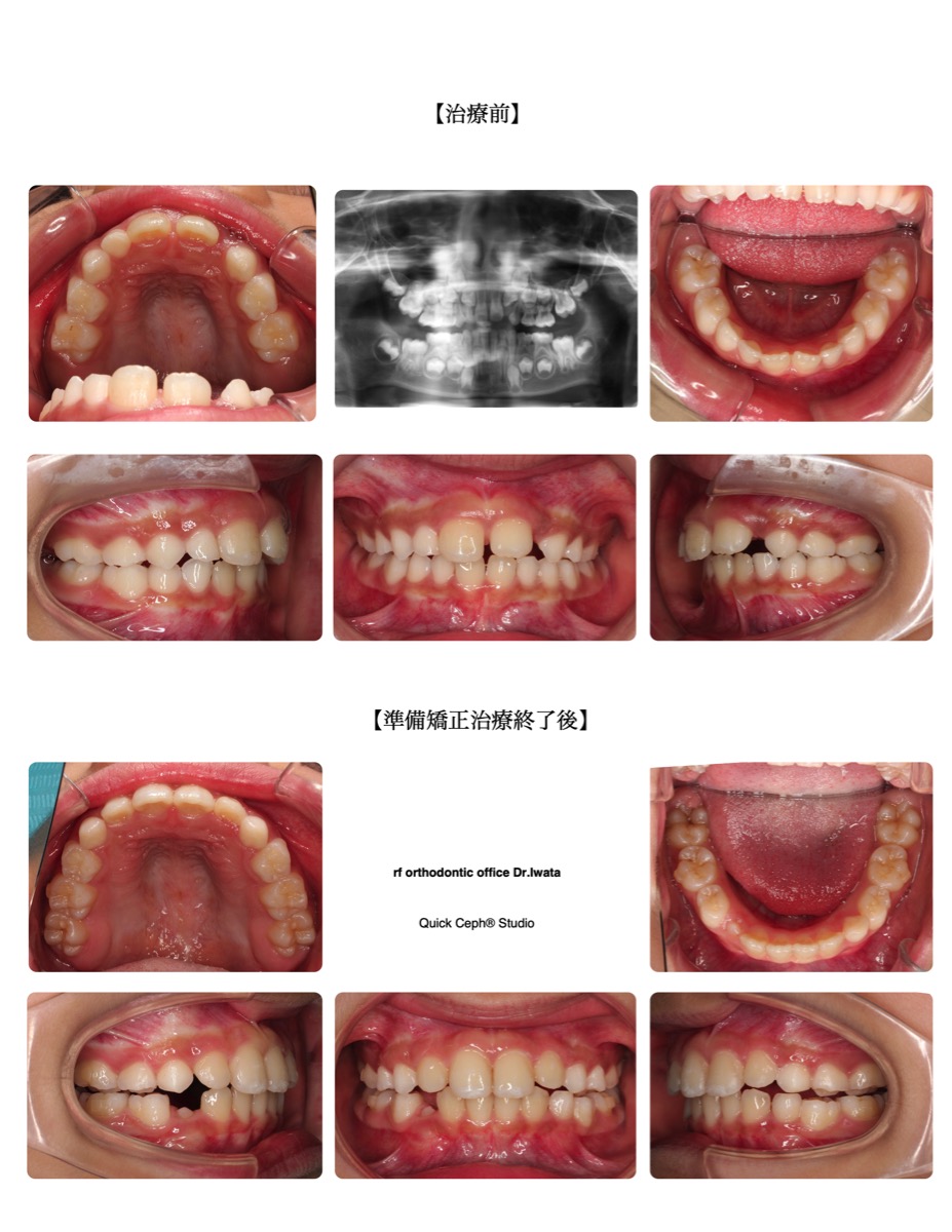 上顎前突症例　＜永久歯の萌出スペース不足を伴う上顎前突に対する準備矯正治療＞