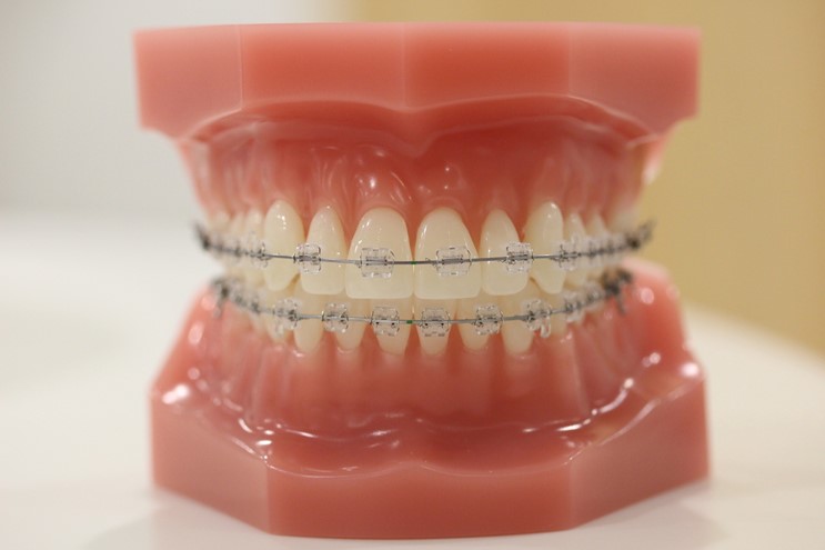 矯正治療中の食生活について