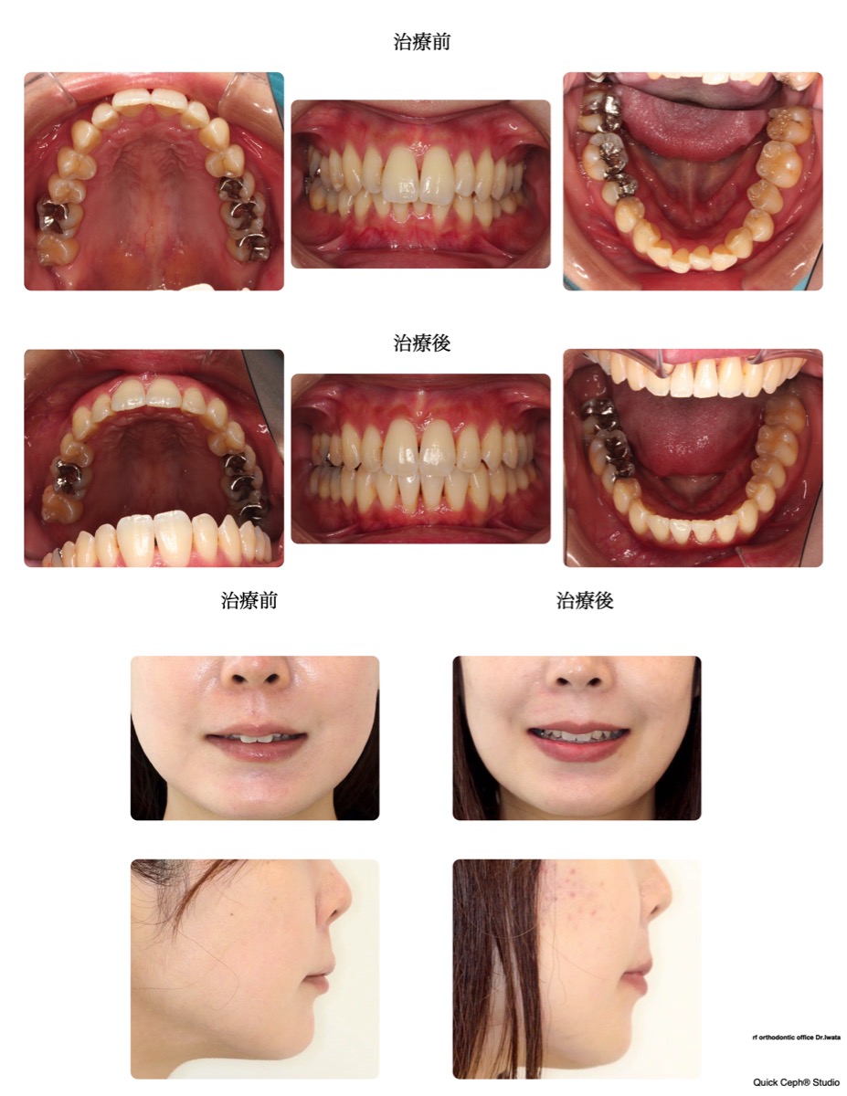 過盖咬合症例　＜叢生と正中のズレを併う過蓋咬合に対する上顎１本抜歯矯正治療＞
