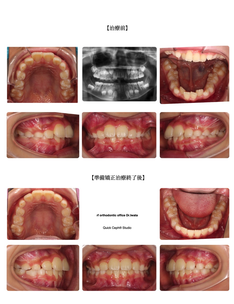 叢生症例　＜上下顎前歯の叢生に対する準備矯正治療＞