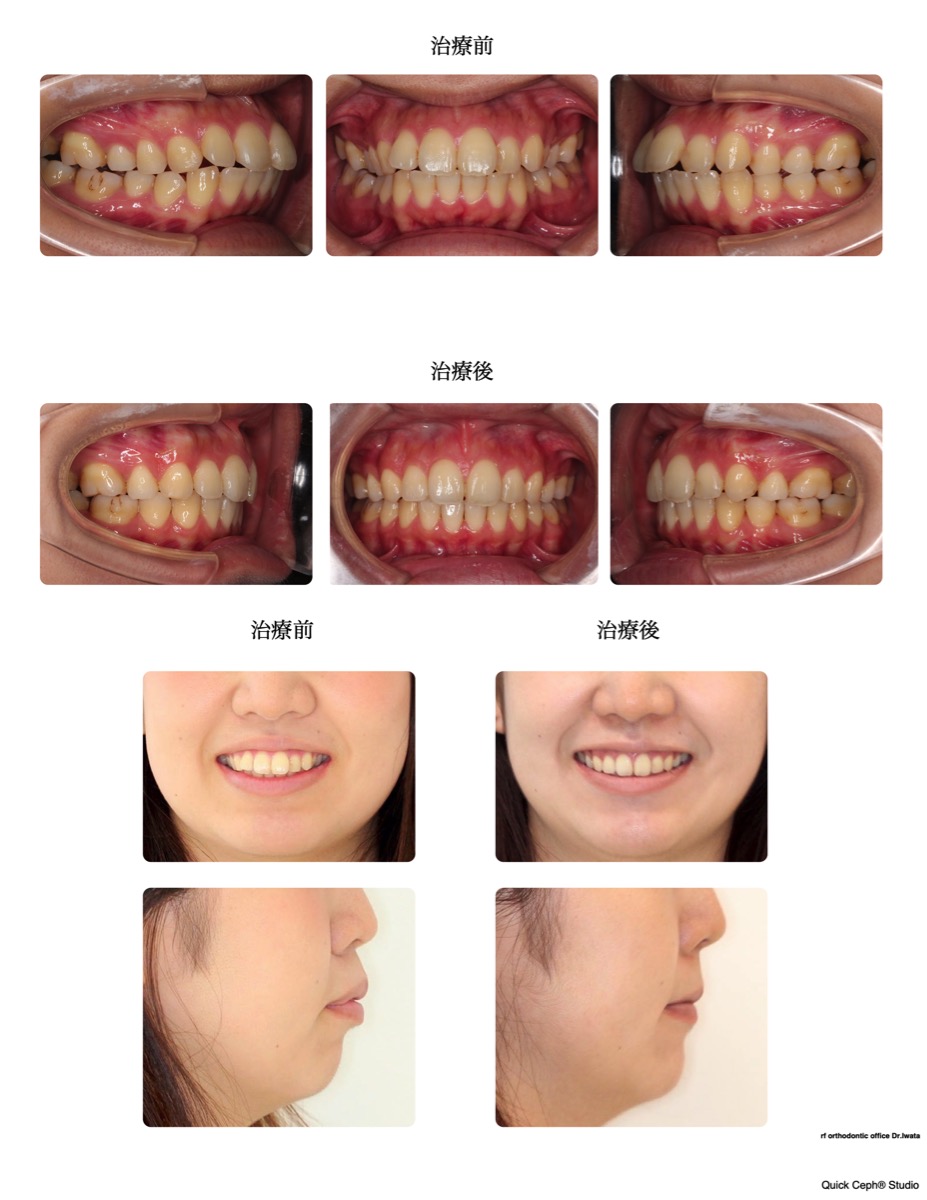 上下顎前突症例 　＜口唇閉鎖不全を伴う上下顎前突に対する抜歯矯正治療＞