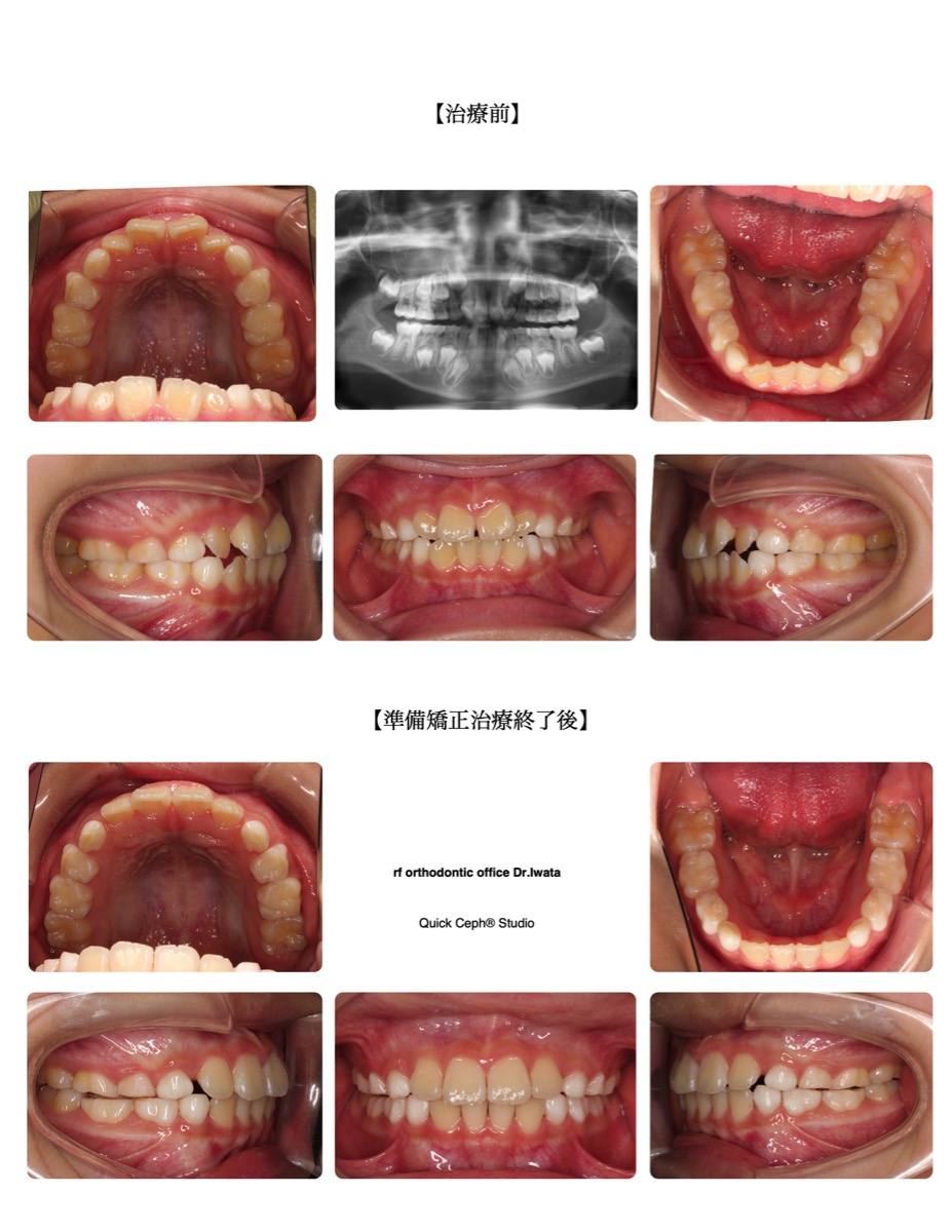 叢生症例　＜上顎前歯翼状捻転を伴う叢生に対する準備矯正治療＞