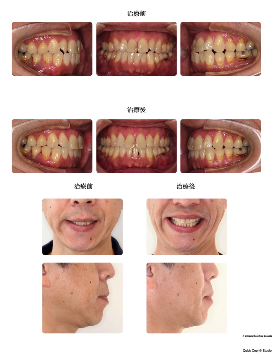 下顎前突症例　＜叢生を伴う反対咬合に対する非抜歯矯正治療＞