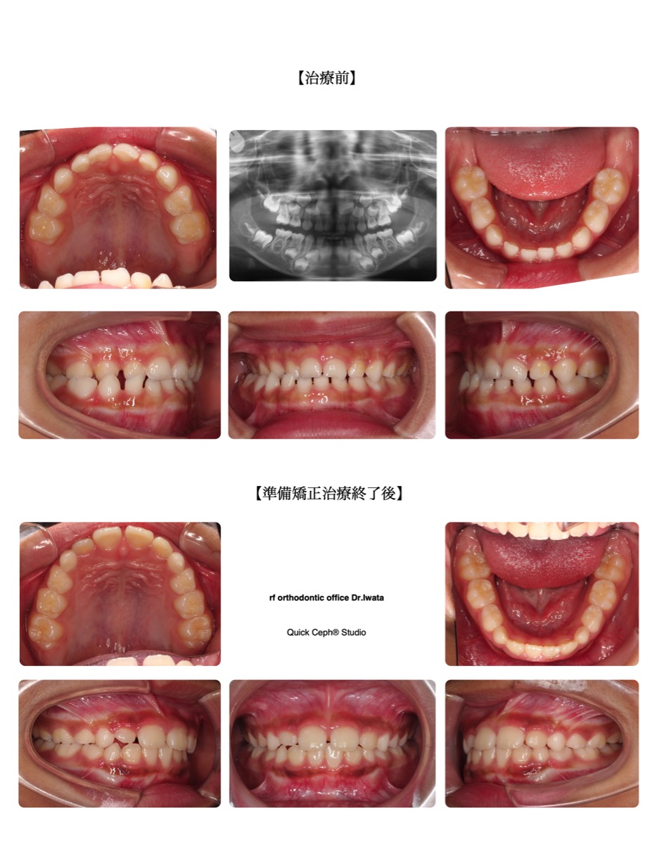 交叉咬合症例　＜交叉咬合による下顎の偏位に対する準備矯正治療＞