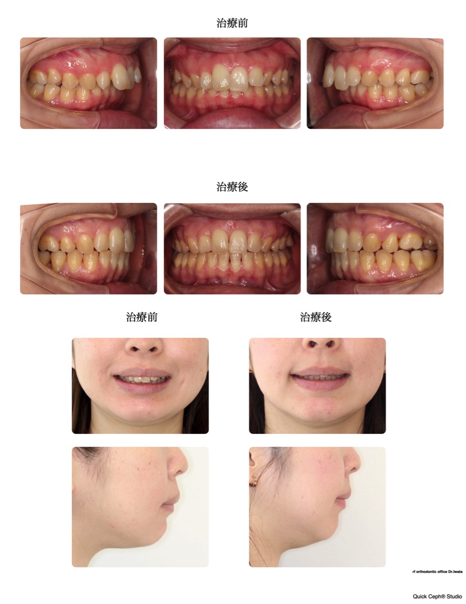 上顎前突症例 　＜過蓋咬合を伴う上顎前突に対してインプラントアンカーを併用した抜歯矯正治療＞