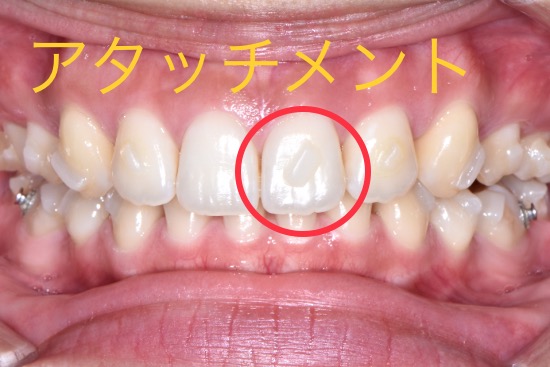 アタッチメントについて