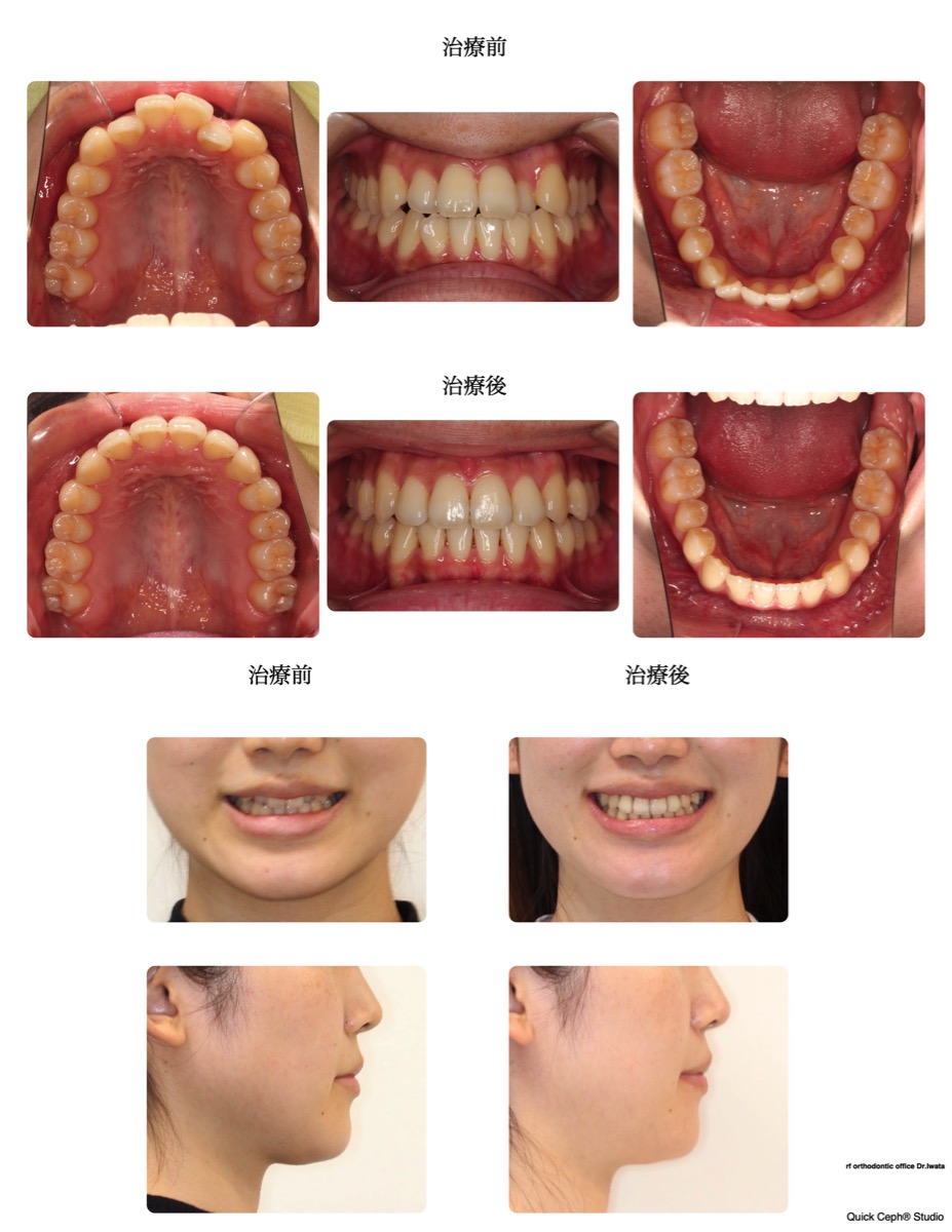 叢生症例　＜前歯部の叢生に対して下顎の遠心移動を行った非抜歯矯正治療＞