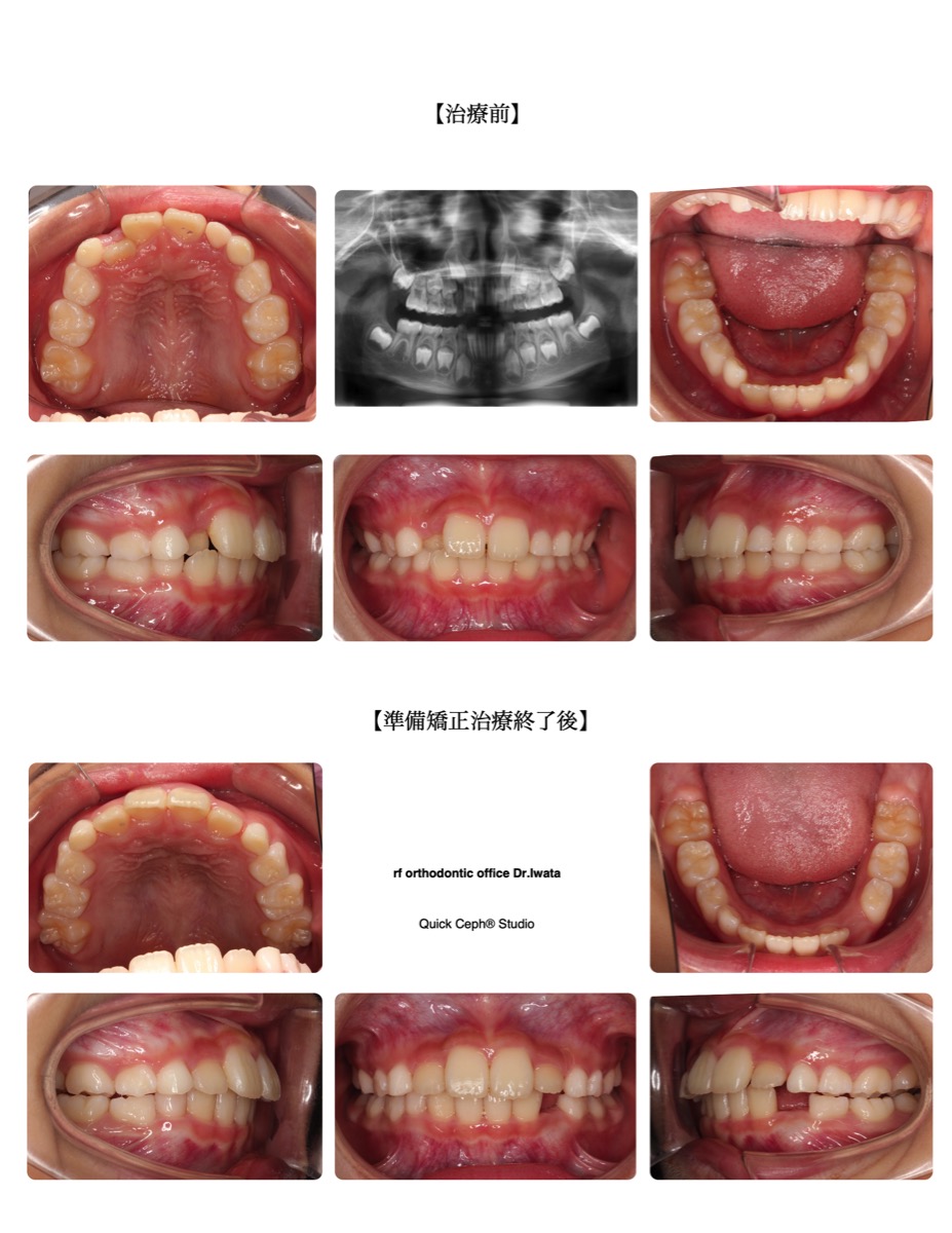 叢生症例　＜上顎前歯の舌側転位を伴う叢生に対する準備矯正治療＞