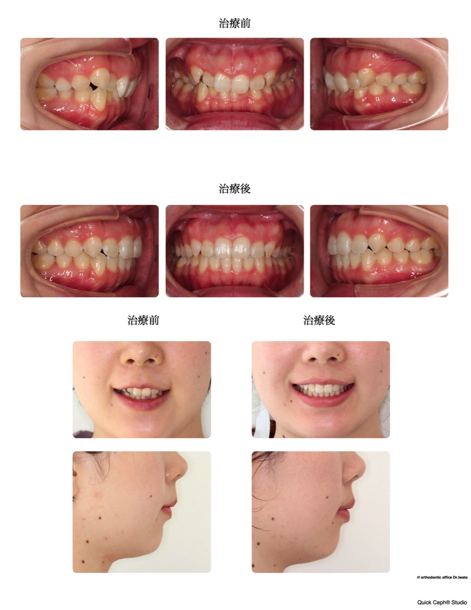 過盖咬合症例　＜上顎前歯の舌側傾斜を併う過蓋咬合に対する非抜歯矯正治療＞