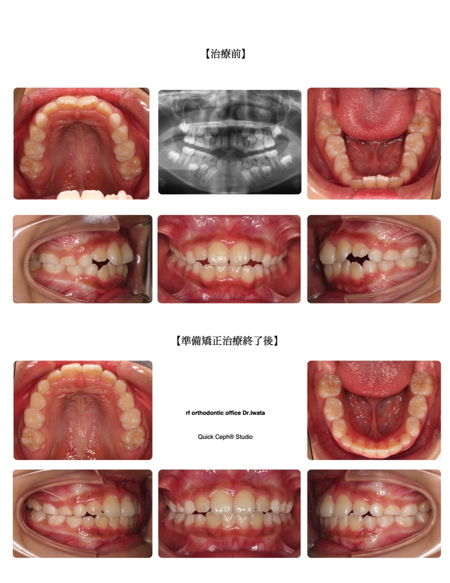 叢生症例　＜前突を伴う叢生に対する準備矯正治療＞
