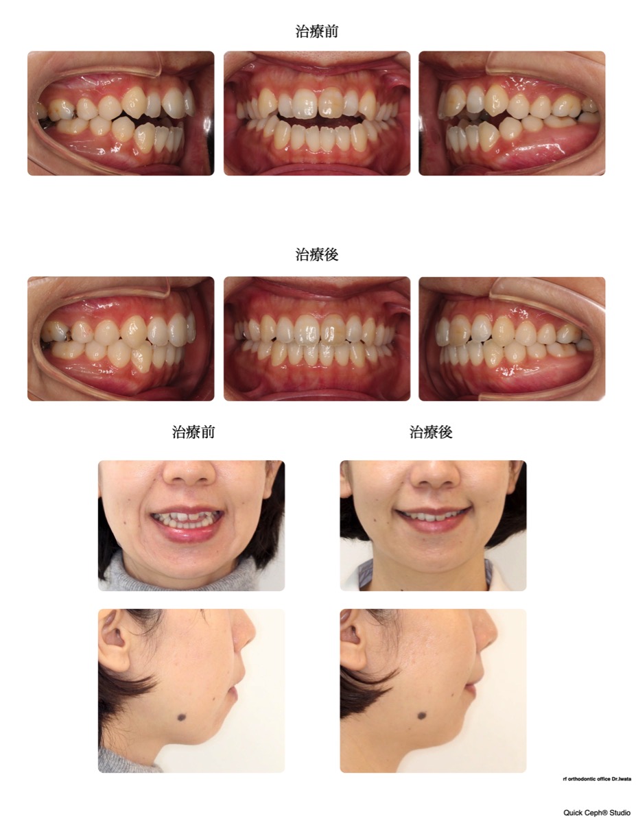 開咬症例 <下顎後退による開咬に対する非抜歯矯正治療>