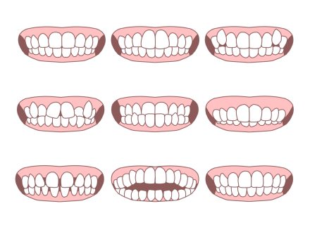 子どもの歯並び