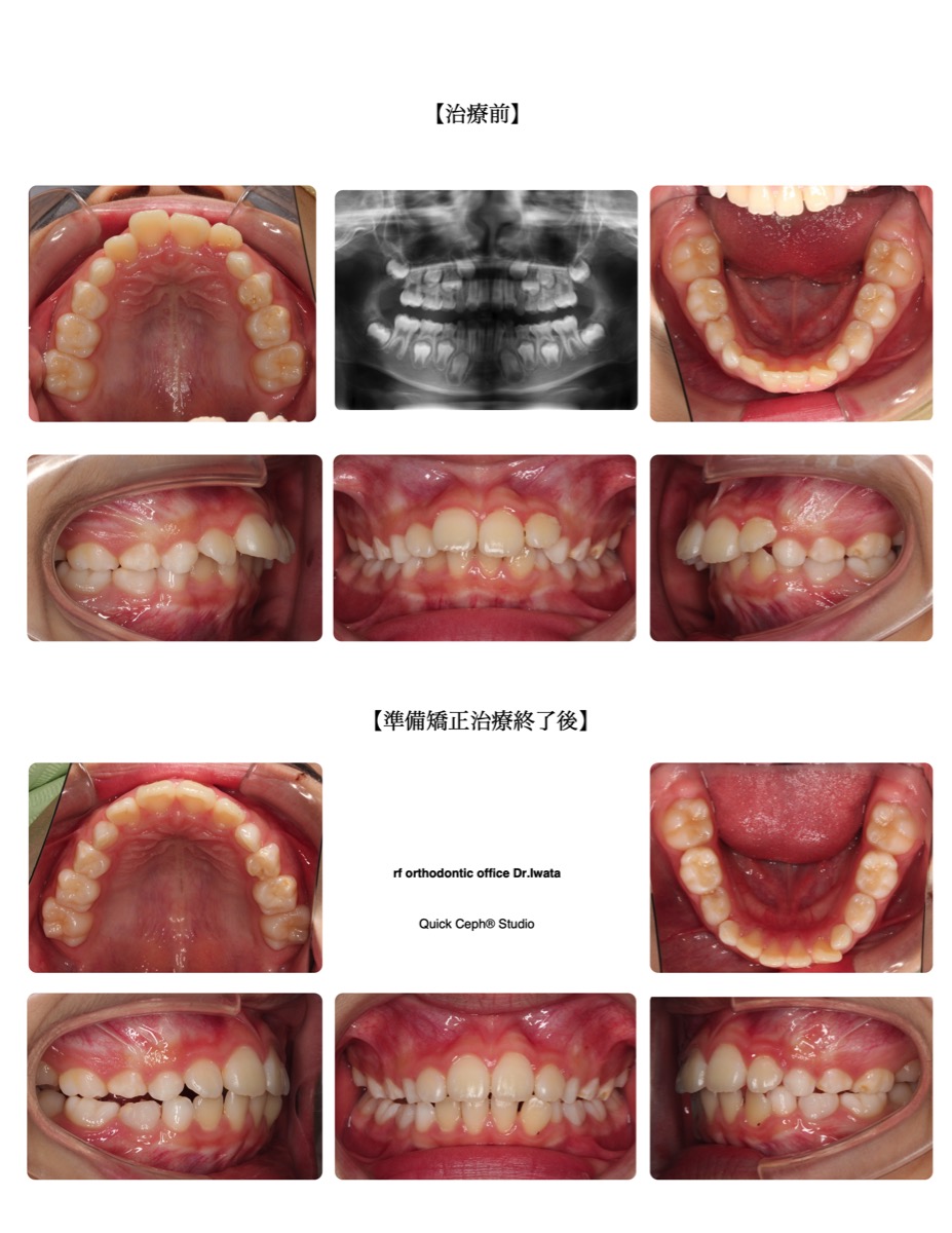 上顎前突症例 <叢生を伴う骨格性下顎後退に対する準備矯正治療>
