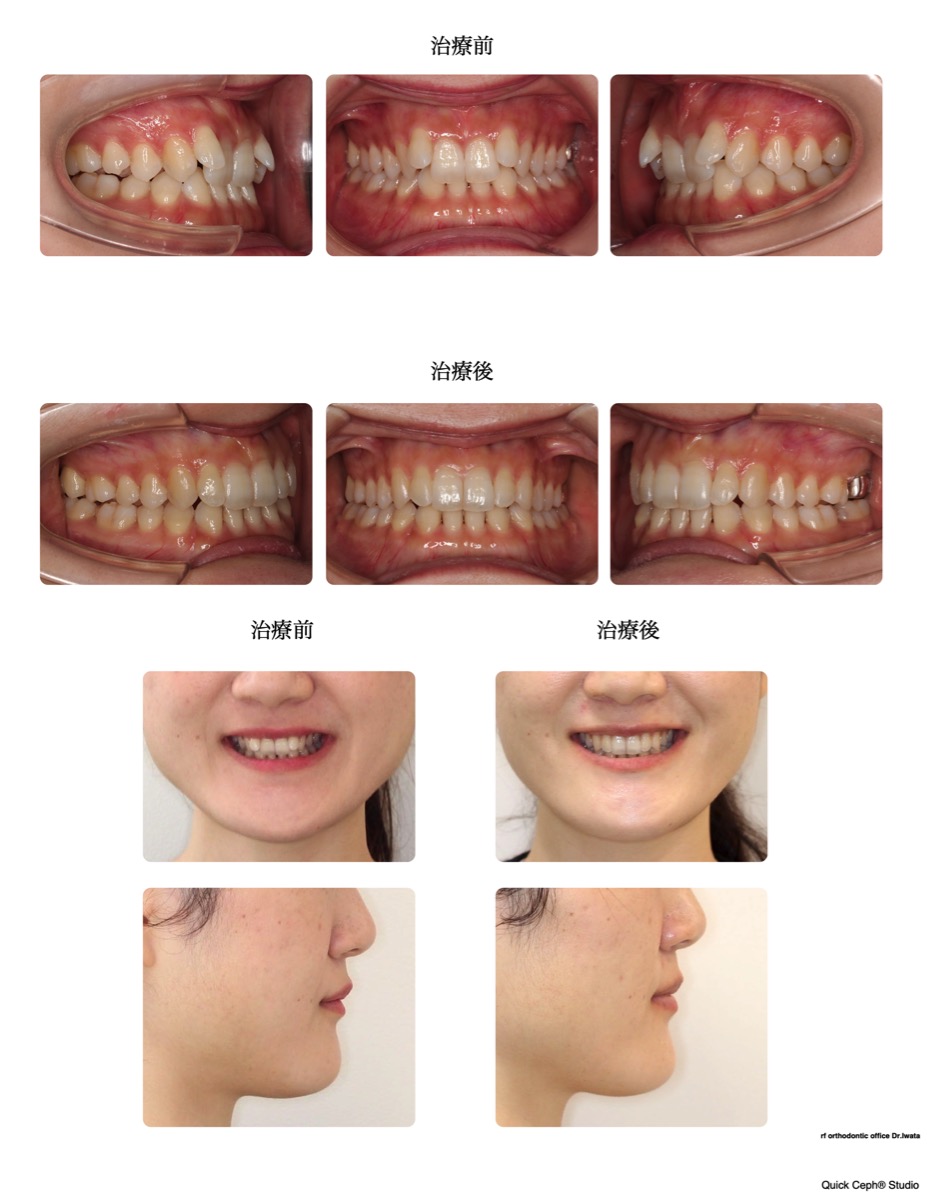 過盖咬合症例 <下顎前歯の先天欠損と上顎前歯の舌側傾斜を併う過蓋咬合に対する非抜歯矯正治療>