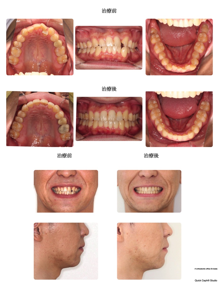 叢生症例 <上下顎前歯の重度叢生に対する非抜歯矯正治療>