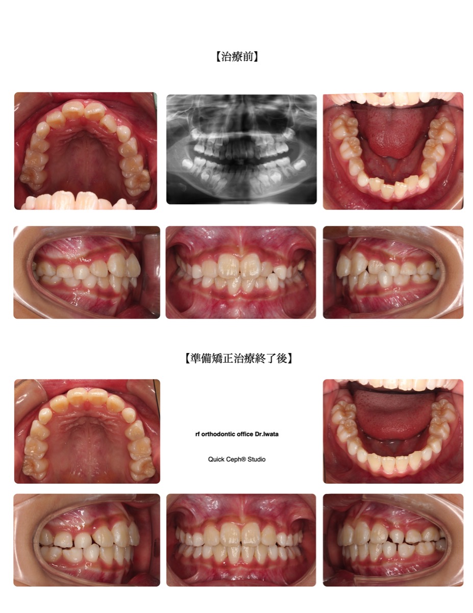 叢生症例 <歯列狭窄を伴う叢生に対する準備矯正治療>