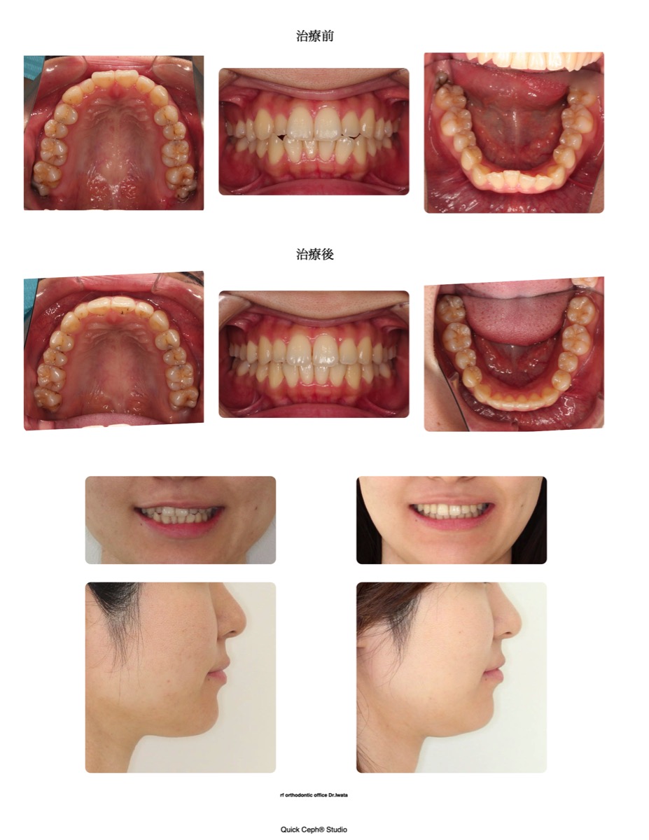 叢生症例 <上顎側切歯の舌側転位を伴う叢生に対する非抜歯矯正治療>